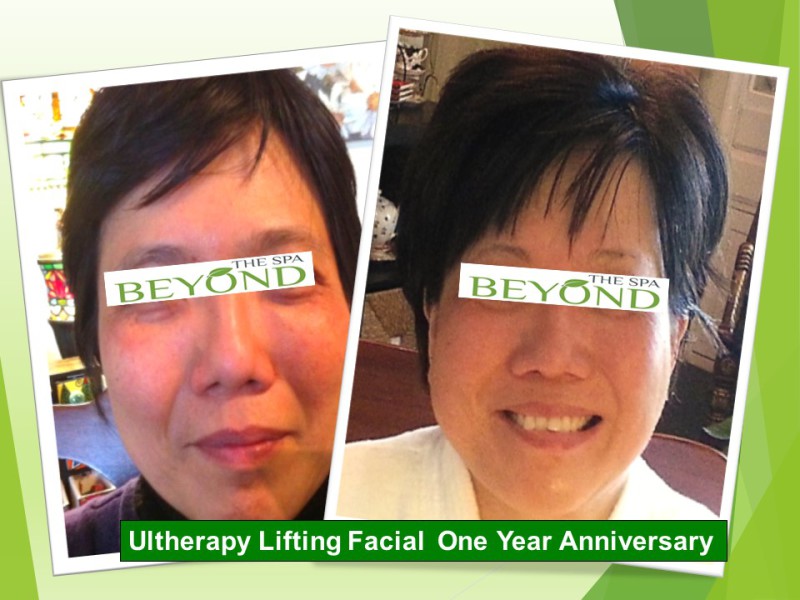 We are #1 Specialized in Ultherapy Face&Neck Lift.